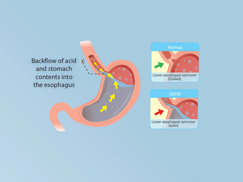 Gastroesophageal reflux disease illustration