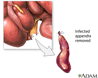 Appendix removed illustration