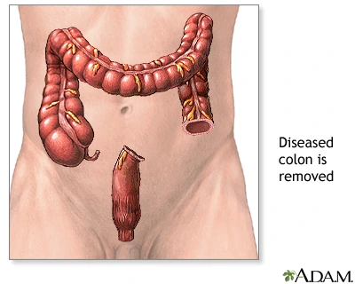 Diseased colon removed illustration