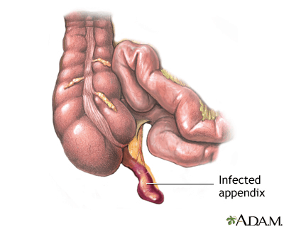 Infected appendix illustration