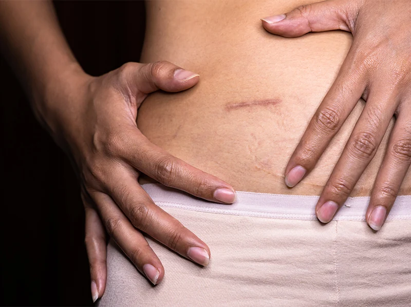 Woman holding hands around appendectomy scar