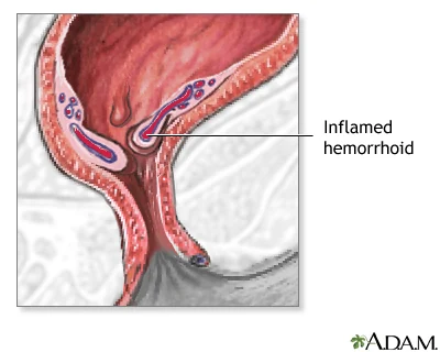 Hemorrhoids illustration