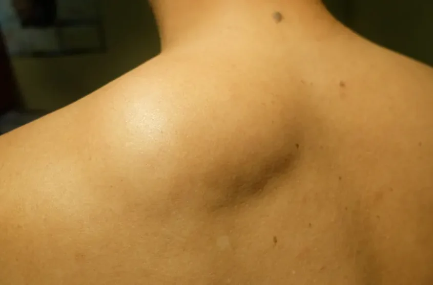 Lipoma on back