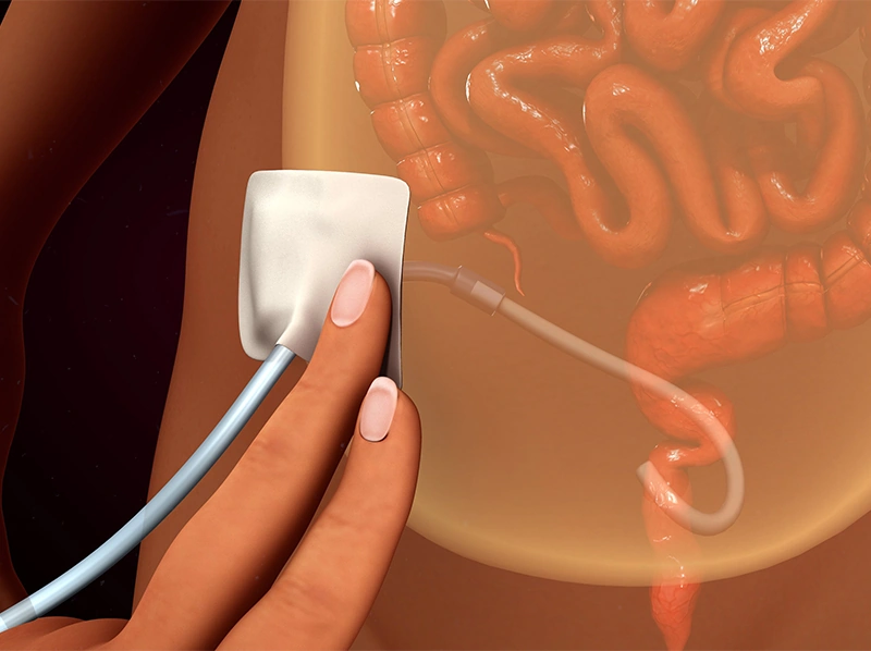 Peritoneal Dialysis Catheter illustration