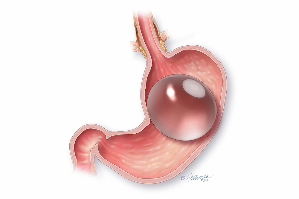 ORBERA in stomach illustration