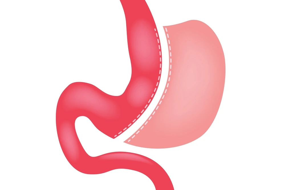 graphic depicting a sleeve gastrectomy