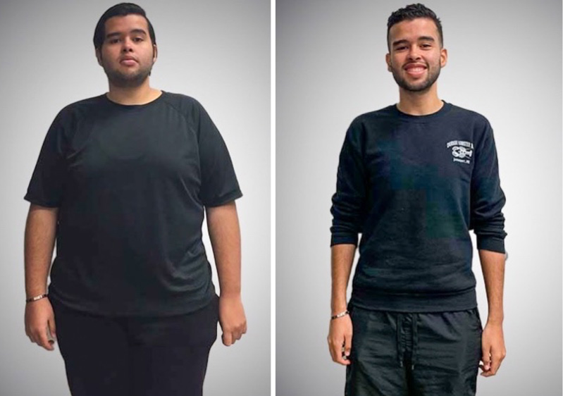 Caleb-Gastric-Sleeve-Before-and-After