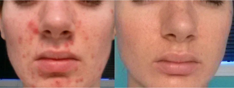 before after morpheus8 acne