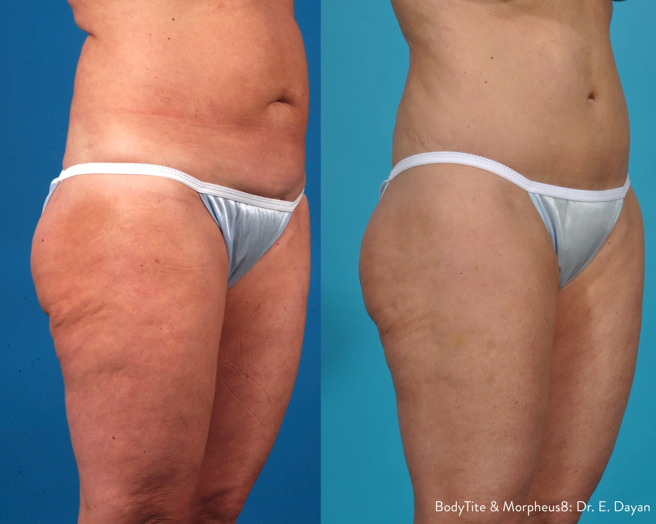 Morpheus8 before and after image of buttox