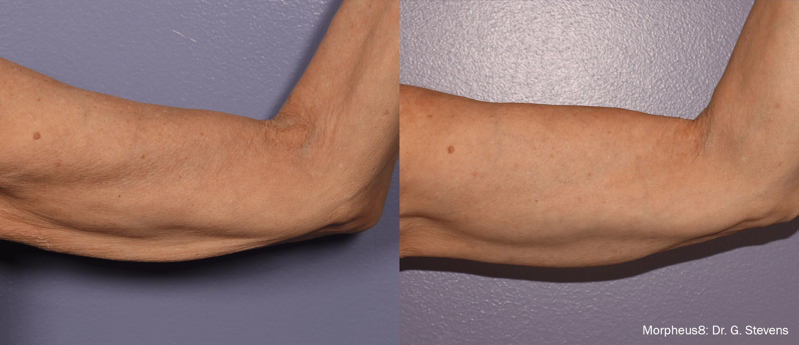 Morpheus8 before and after gallery for under arm