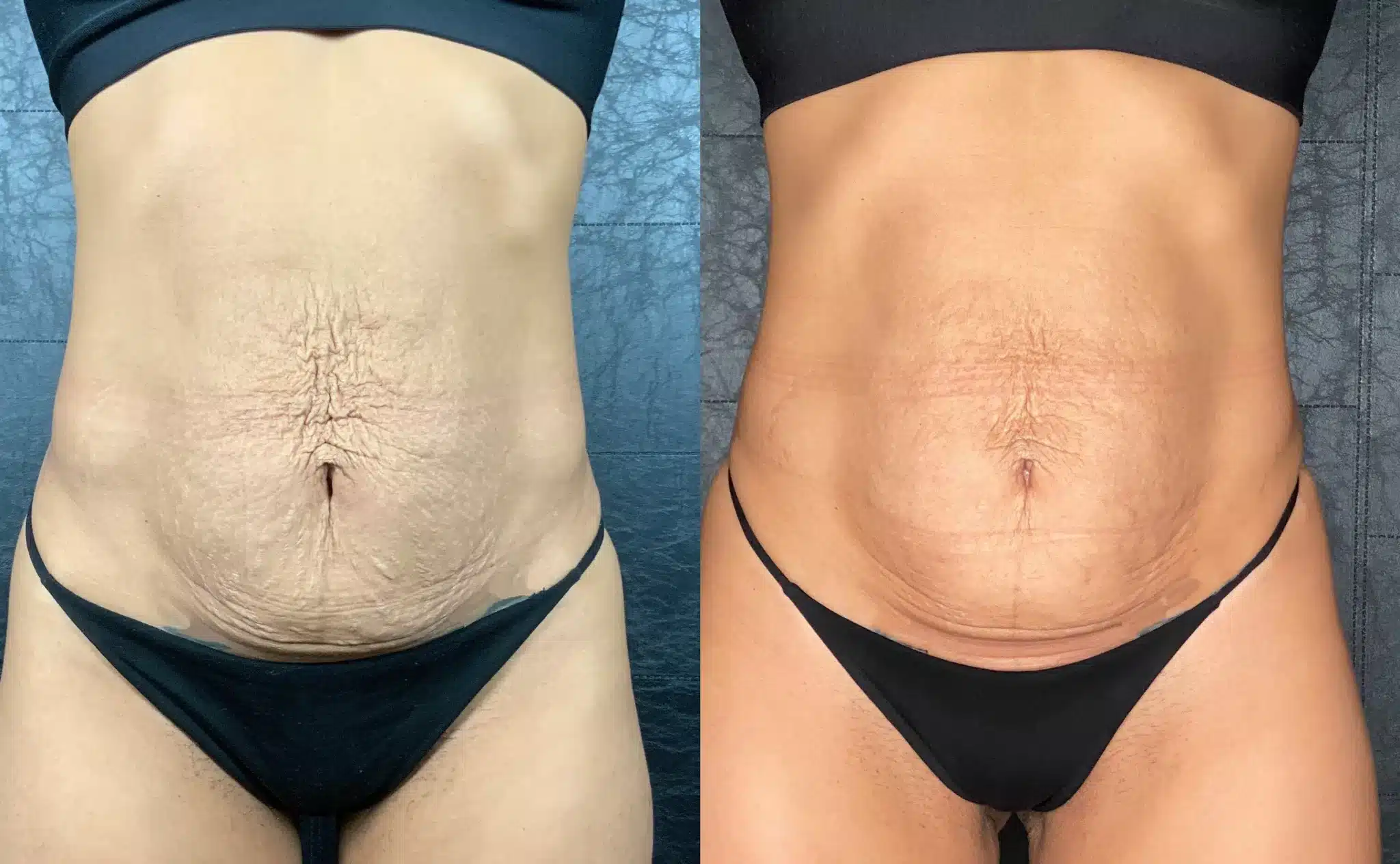 Morpheus8 treatment on torso