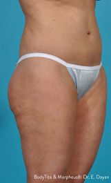 Photo of woman's torso after Morpheus8