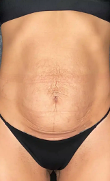 Photo of woman's stomach after Morpheus8