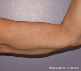 Photo of woman's arm after Morpheus8