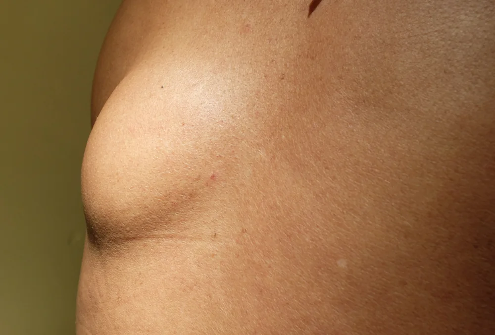 lipoma on the back of a male patient